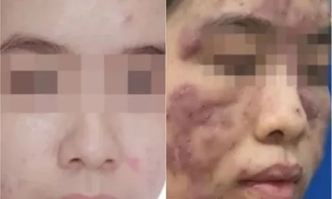 Tin lời 'bác sĩ online' cô gái trẻ bị biến dạng gương mặt
