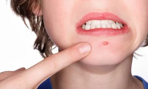 Mẹo trị mụn bọc tại nhà, rẻ tiền, hiệu quả ai cũng làm được